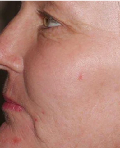 After Fraxel treatment before and after results