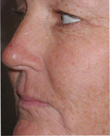 Before Fraxel treatment before and after results